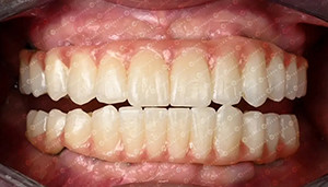 último caso de la compañía sobre Caso del cliente. Bloque de zirconia 4D.