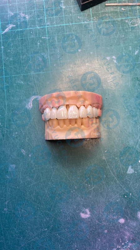 Yucera 4D Pro High-Performance Dental Zirconia Blocks for Precision Milling