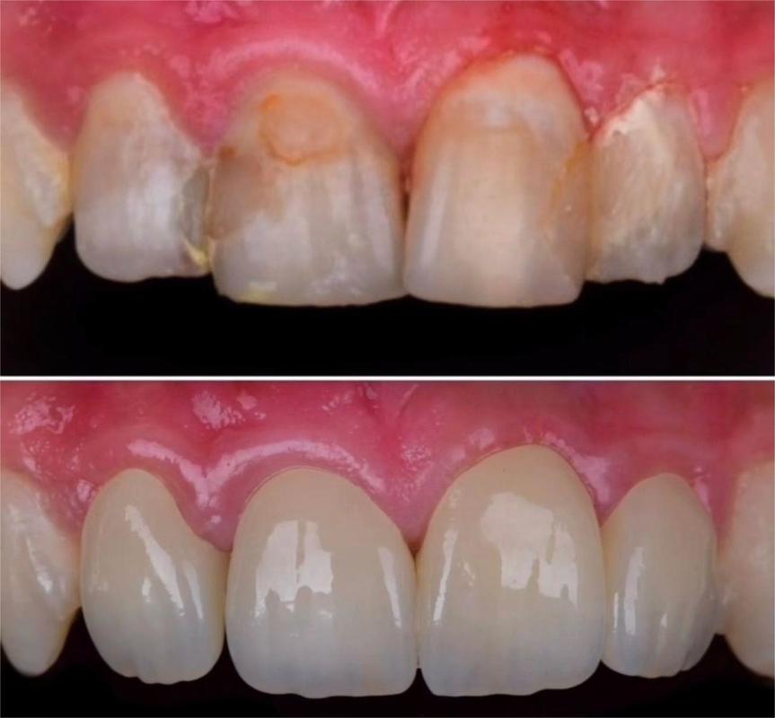 43%-57% Translucidez 700-1200 MPa Resistencia a la Flexión Bloque de Zirconia Multicapa 4D Pro YUCERA Dental de 89mm CAD/CAM