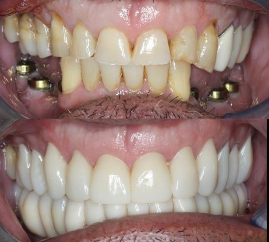 Yucera 4D Pro Alta - Transparencia y Alto - Brillo Bloque de Cerámica de Zirconio Dental Comparable a Dientes Reales